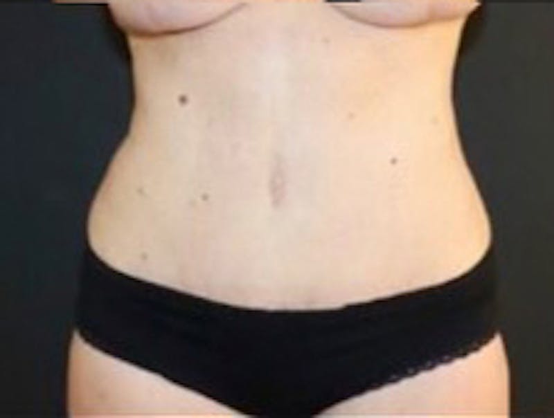 Mommy Makeover Before & After Gallery - Patient 183157 - Image 4