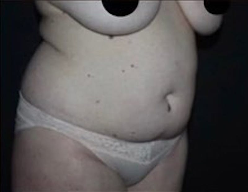 Mommy Makeover Before & After Gallery - Patient 183157 - Image 5