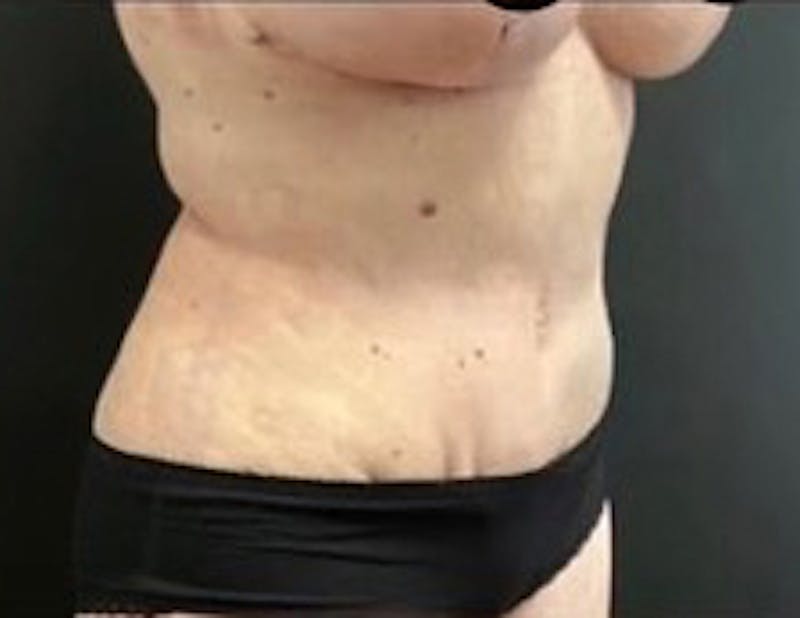 Mommy Makeover Before & After Gallery - Patient 183157 - Image 6