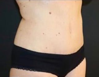 Mommy Makeover Before & After Gallery - Patient 183157 - Image 8