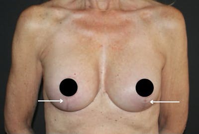 Scar Treatment Before & After Gallery - Patient 412712 - Image 1