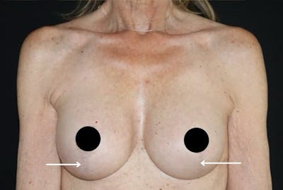 Scar Treatment Before & After Gallery - Patient 412712 - Image 2