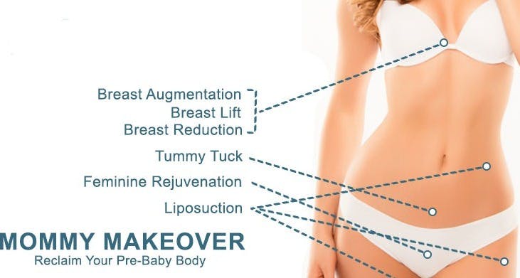 mommy makeover diagram