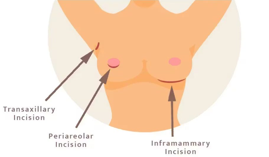 breast aug infographic