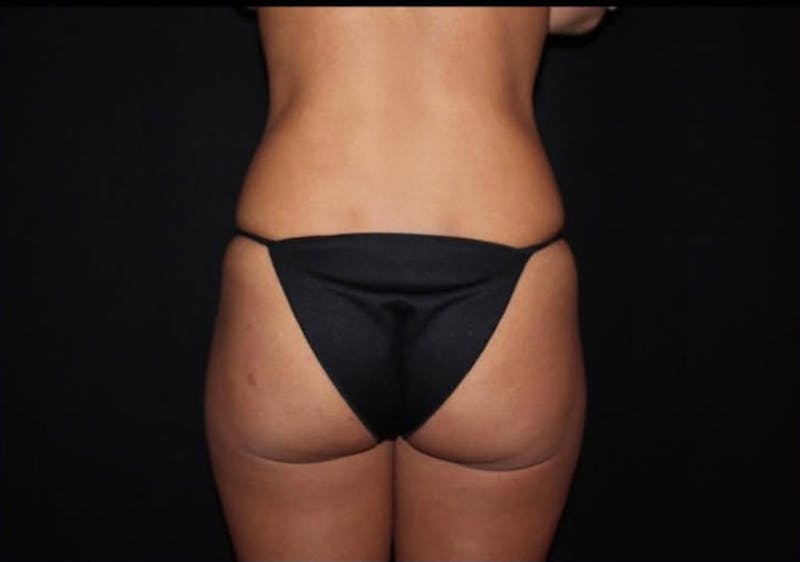 Brazilian Butt Lift Before & After Gallery - Patient 303547 - Image 1
