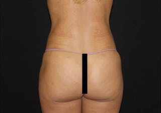 Brazilian Butt Lift Before & After Gallery - Patient 303547 - Image 2