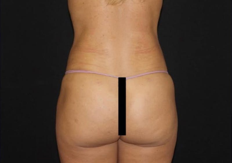 Brazilian Butt Lift Before & After Gallery - Patient 303547 - Image 2