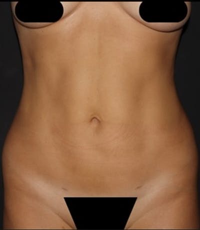 Liposuction Before & After Gallery - Patient 180600 - Image 2
