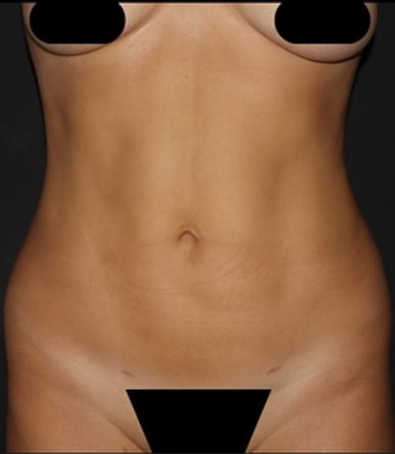 Liposuction Before & After Gallery - Patient 180600 - Image 2