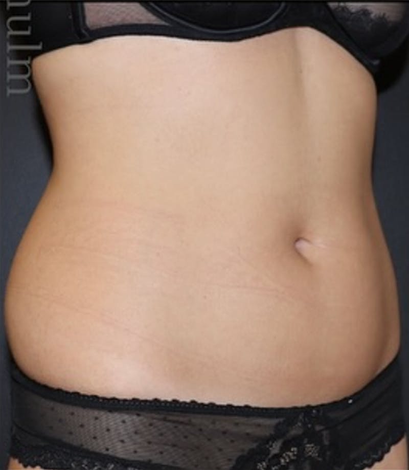 Liposuction Before & After Gallery - Patient 180600 - Image 3
