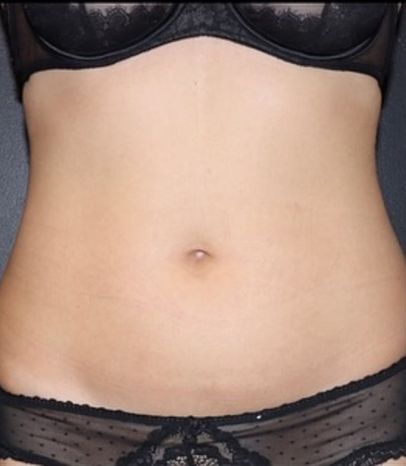 Liposuction Before & After Gallery - Patient 180600 - Image 1