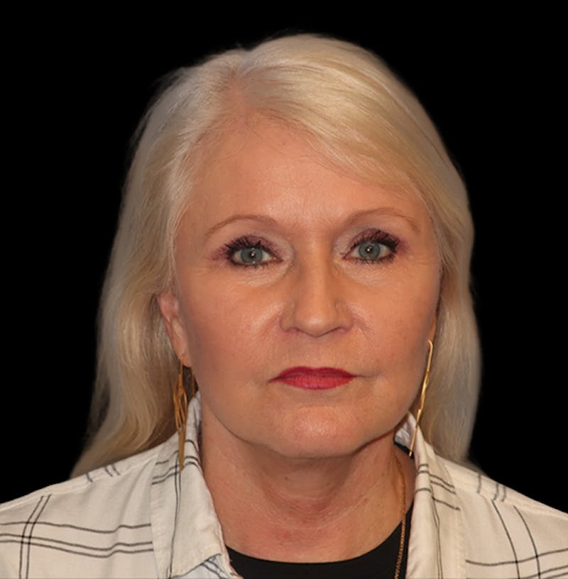 Face and Necklift Before & After Gallery - Patient 879131 - Image 4