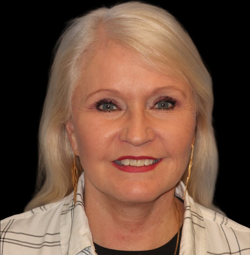 Face and Necklift Before & After Gallery - Patient 879131 - Image 6