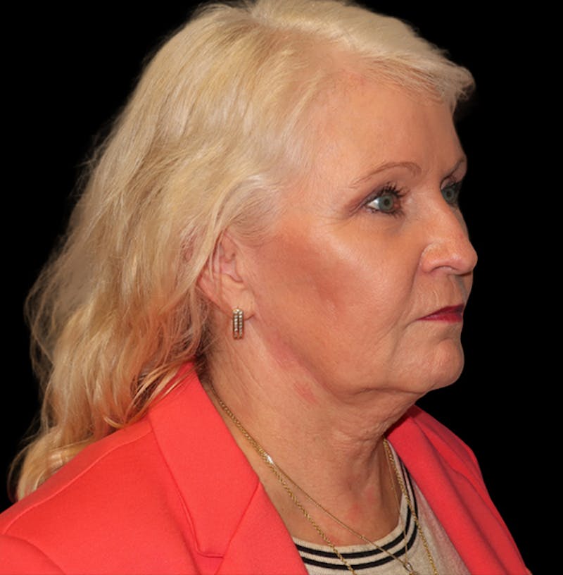 Face and Necklift Before & After Gallery - Patient 879131 - Image 7
