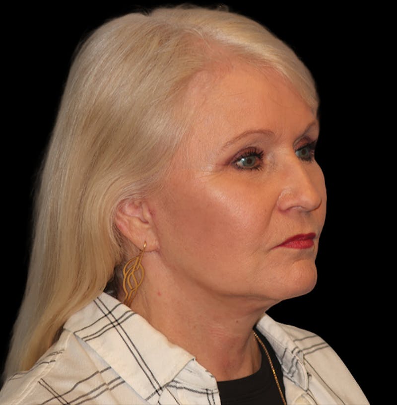 Face and Necklift Before & After Gallery - Patient 879131 - Image 8