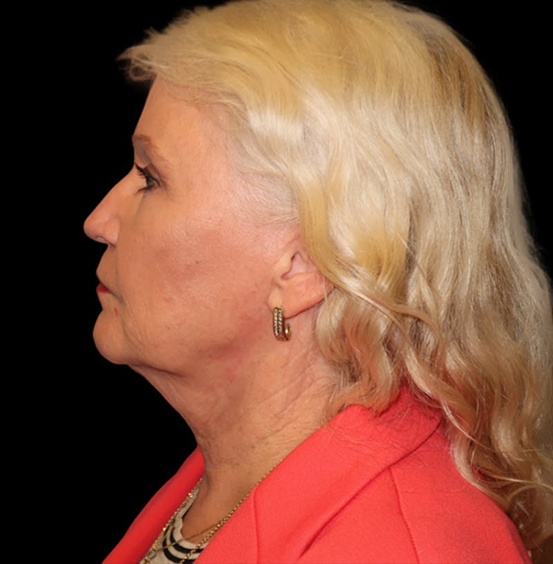 Face and Necklift Before & After Gallery - Patient 879131 - Image 1