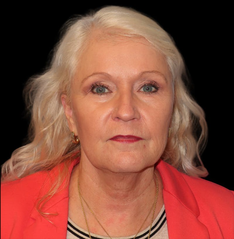 Face and Necklift Before & After Gallery - Patient 879131 - Image 5