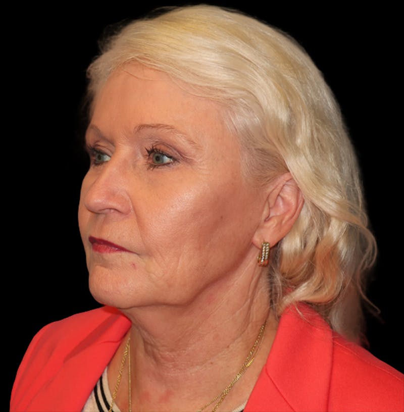 Face and Necklift Before & After Gallery - Patient 879131 - Image 9