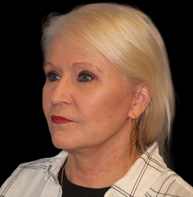 Face and Necklift Before & After Gallery - Patient 879131 - Image 10