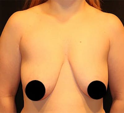 Breast Lift Before & After Gallery - Patient 268085 - Image 1