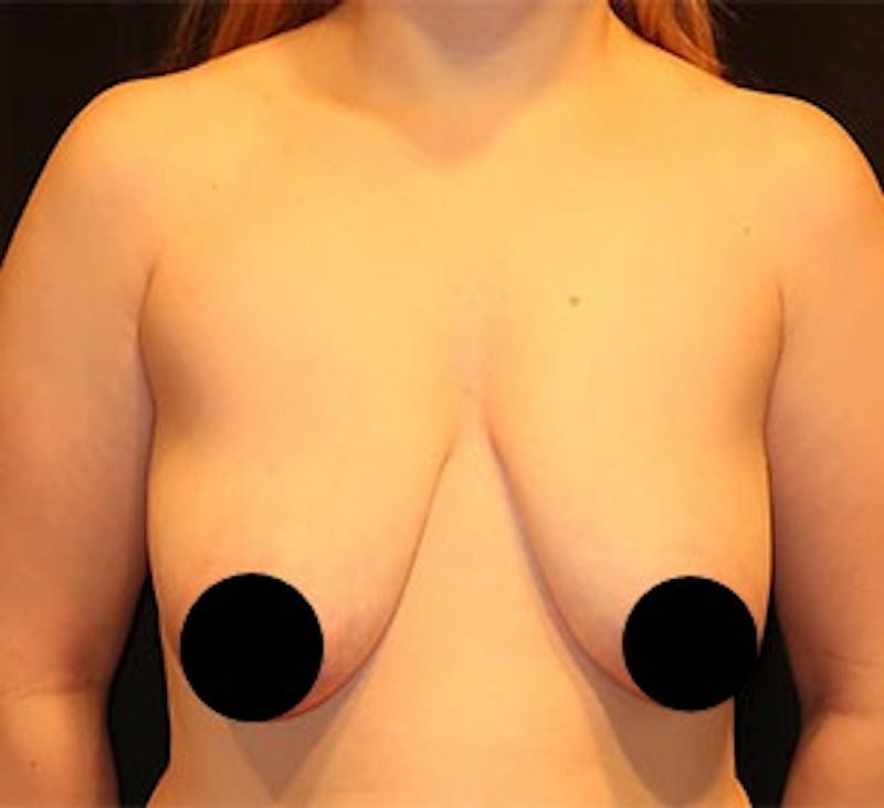 Breast Lift Before & After Gallery - Patient 268085 - Image 1