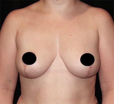 Breast Lift Before & After Gallery - Patient 268085 - Image 2