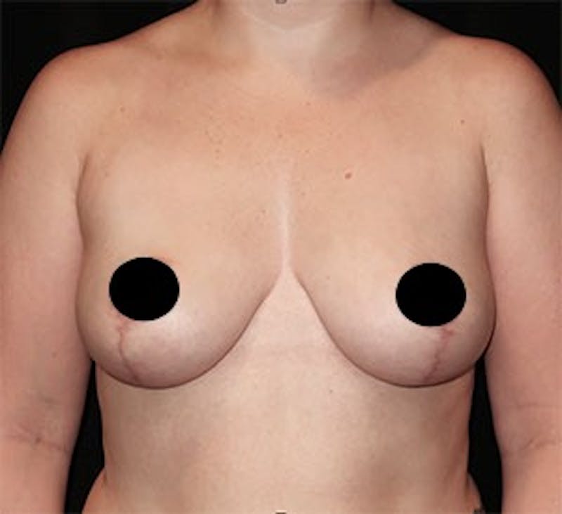 Breast Lift Before & After Gallery - Patient 268085 - Image 2