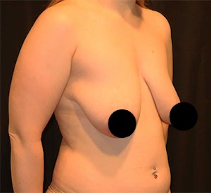 Breast Lift Before & After Gallery - Patient 268085 - Image 3