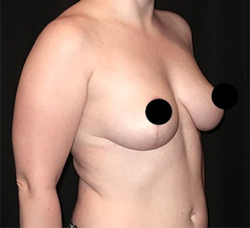 Breast Lift Before & After Gallery - Patient 268085 - Image 4