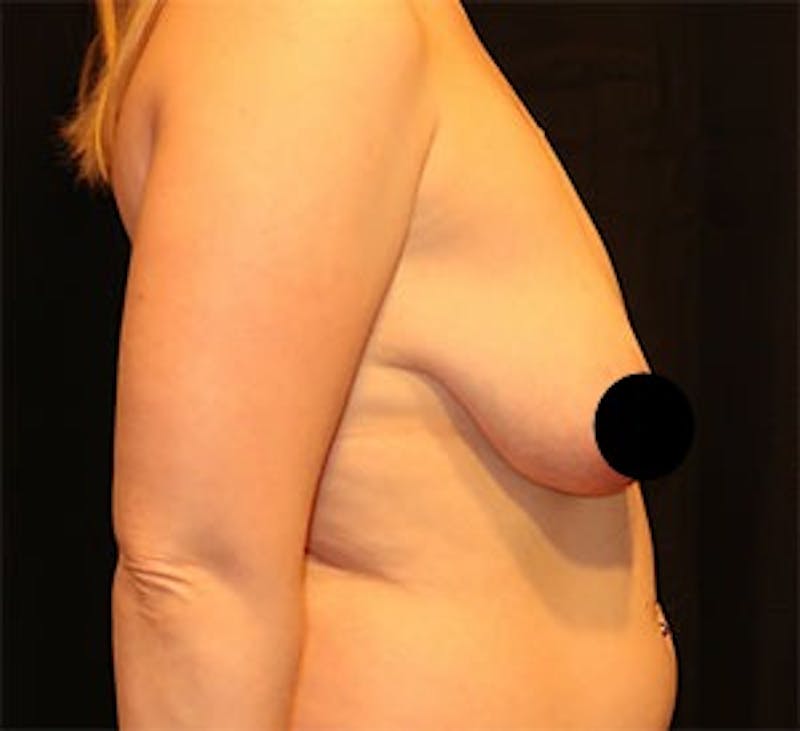 Breast Lift Before & After Gallery - Patient 268085 - Image 5