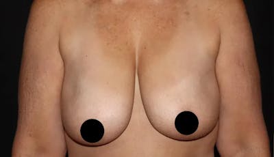 Breast Lift Before & After Gallery - Patient 220028 - Image 1