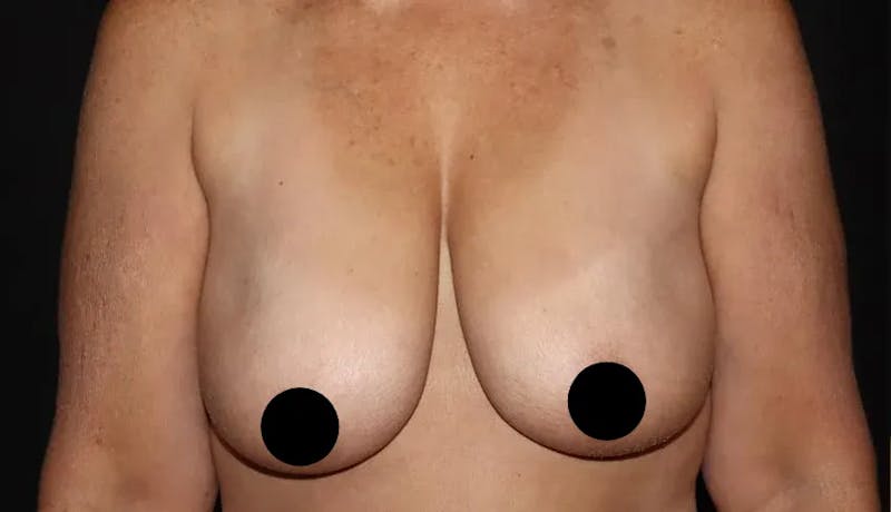 Breast Lift Before & After Gallery - Patient 220028 - Image 1