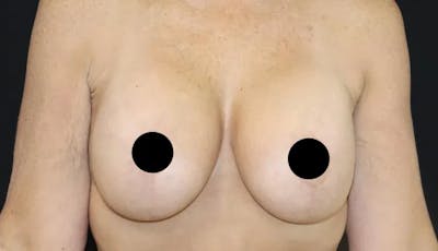 Breast Lift Before & After Gallery - Patient 220028 - Image 2