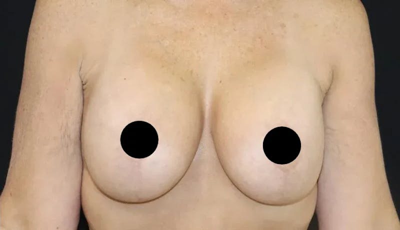 Breast Lift Before & After Gallery - Patient 220028 - Image 2