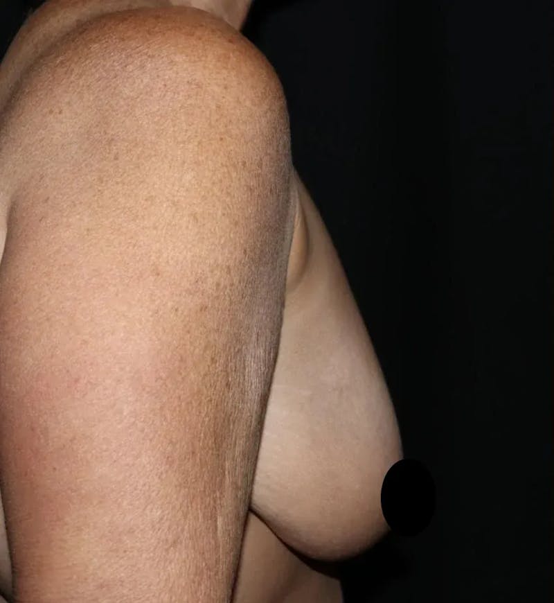 Breast Lift Before & After Gallery - Patient 220028 - Image 3