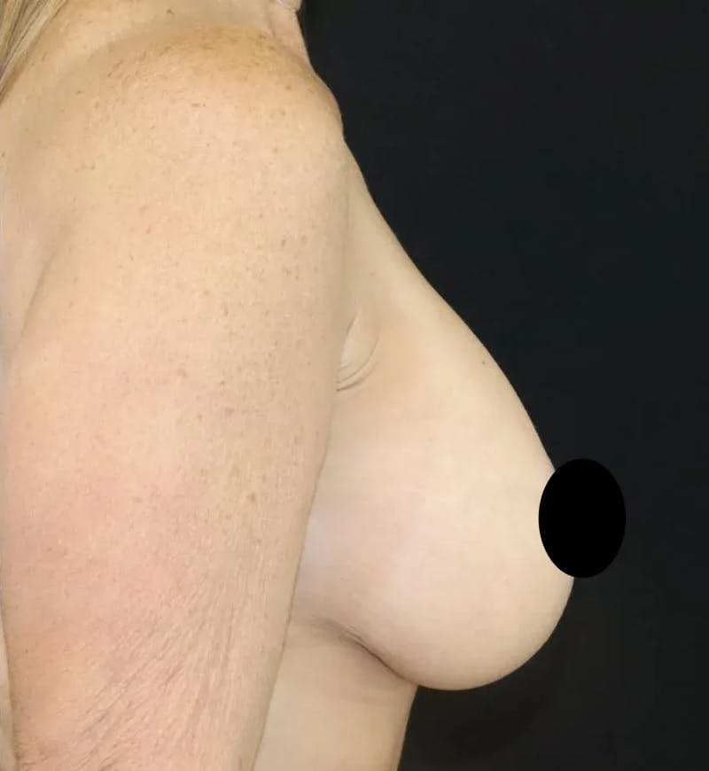 Breast Lift Before & After Gallery - Patient 220028 - Image 4