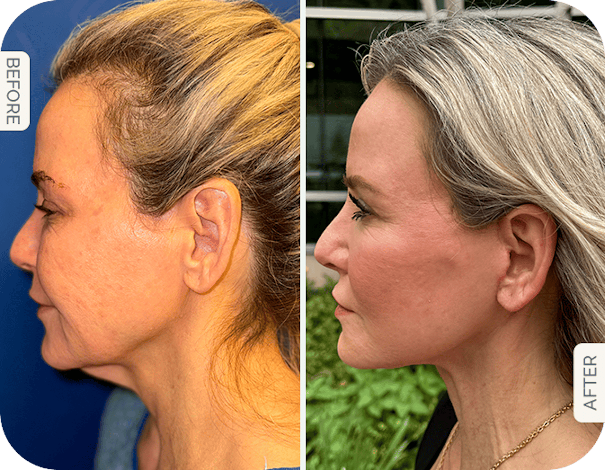 Miami Facelift/Neck Lift Before & After Gallery - Patient 300544 - Image 1 - The Chopra Plastic Surgery Center