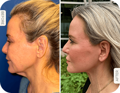Miami Facelift/Neck Lift Before & After Gallery - Patient 300544 - Image 1 - The Chopra Plastic Surgery Center