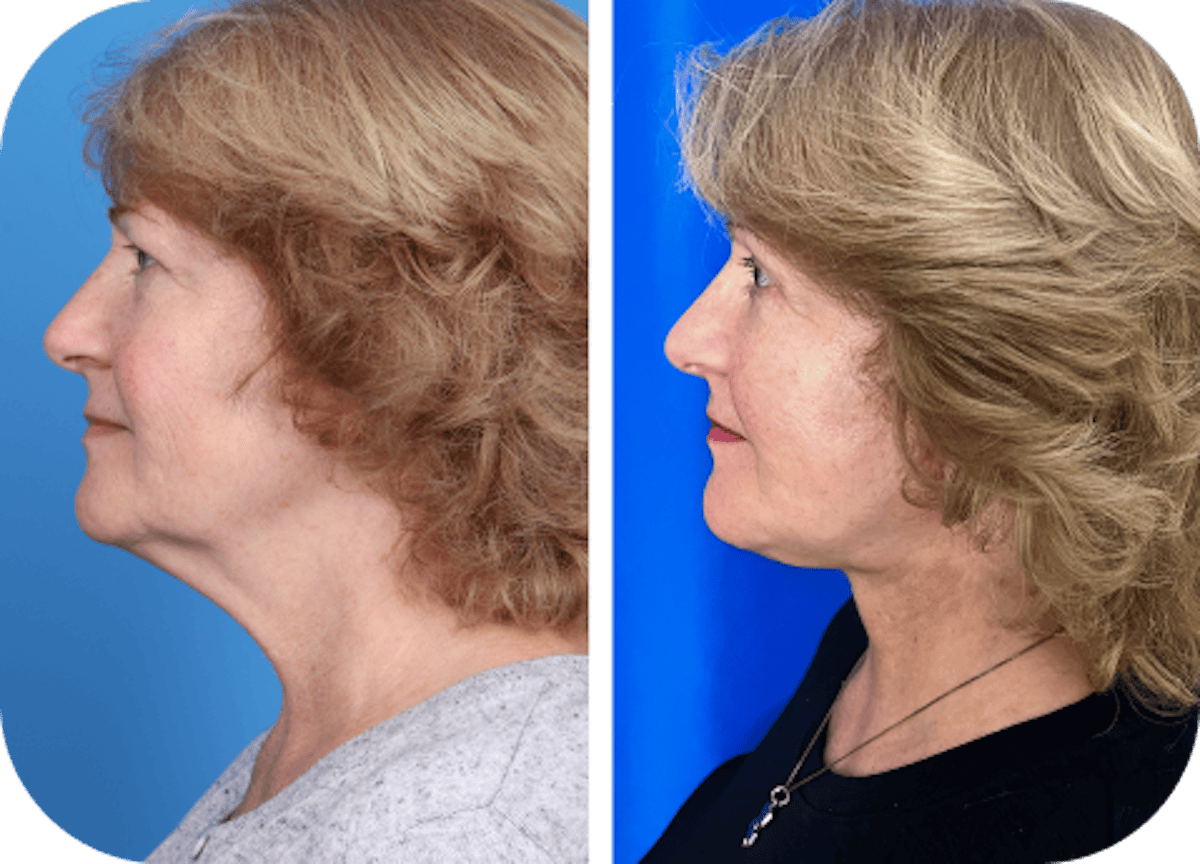 Miami Facial Fat Grafting Before & After Gallery - Patient 376011 - Image 1 - The Chopra Plastic Surgery Center
