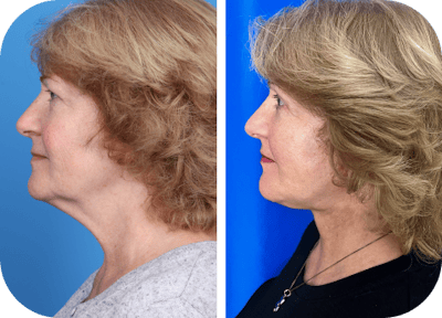 Miami Facial Fat Grafting Before & After Gallery - Patient 376011 - Image 1 - The Chopra Plastic Surgery Center
