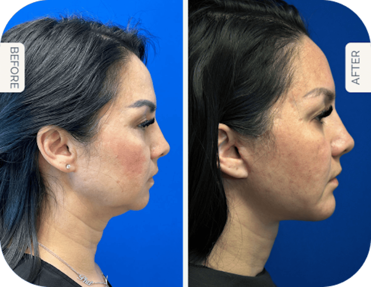 Miami Facelift/Neck Lift Before & After Gallery - Patient 200442 - Image 1 - The Chopra Plastic Surgery Center