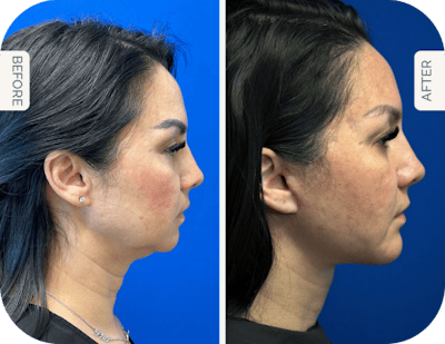 Miami Facelift/Neck Lift Before & After Gallery - Patient 200442 - Image 1 - The Chopra Plastic Surgery Center