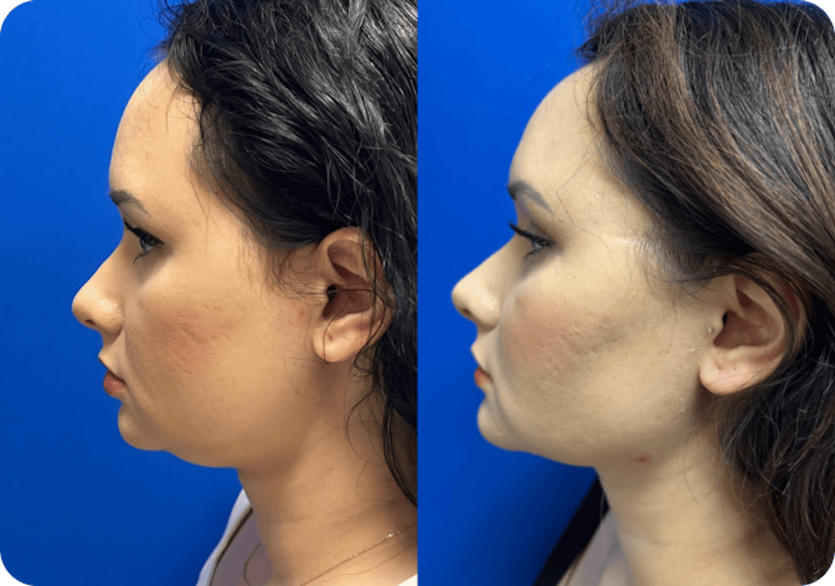 Miami Chin Augmentation Before & After Gallery - Patient 176548 - Image 1 - The Chopra Plastic Surgery Center