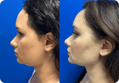 Miami Chin Augmentation Before & After Gallery - Patient 176548 - Image 1 - The Chopra Plastic Surgery Center