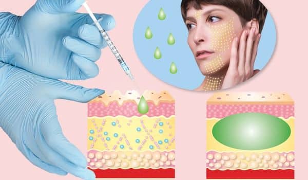 dermal fillers for sunken cheeks