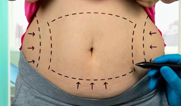 liposuction to get a flat stomach
