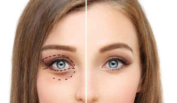 Mistakes with blepharoplasty