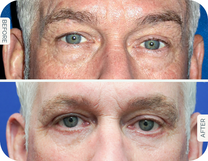 Before and after blog