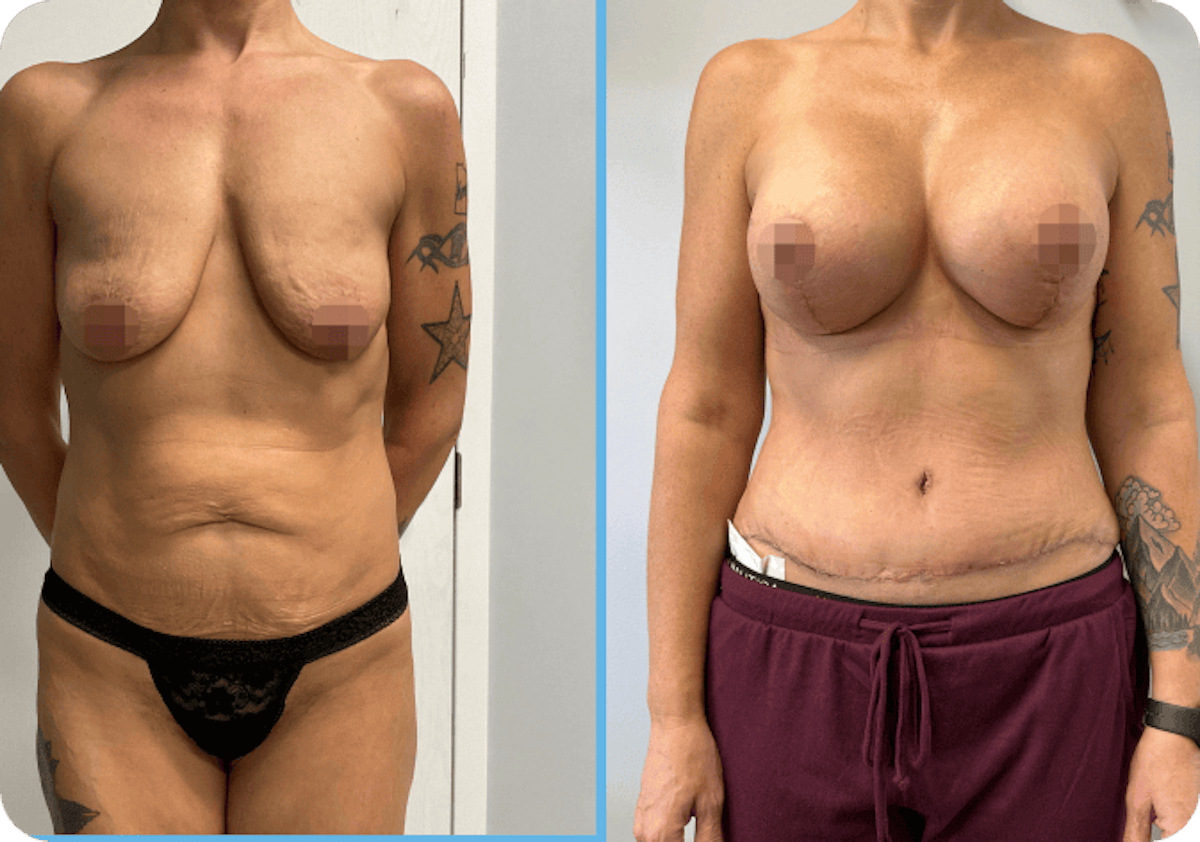Miami Mommy Makeover Before & After Gallery - Patient 713869 - Image 1 - The Chopra Plastic Surgery Center