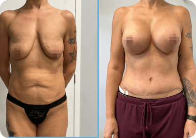 Miami Mommy Makeover Before & After Gallery - Patient 713869 - Image 1 - The Chopra Plastic Surgery Center
